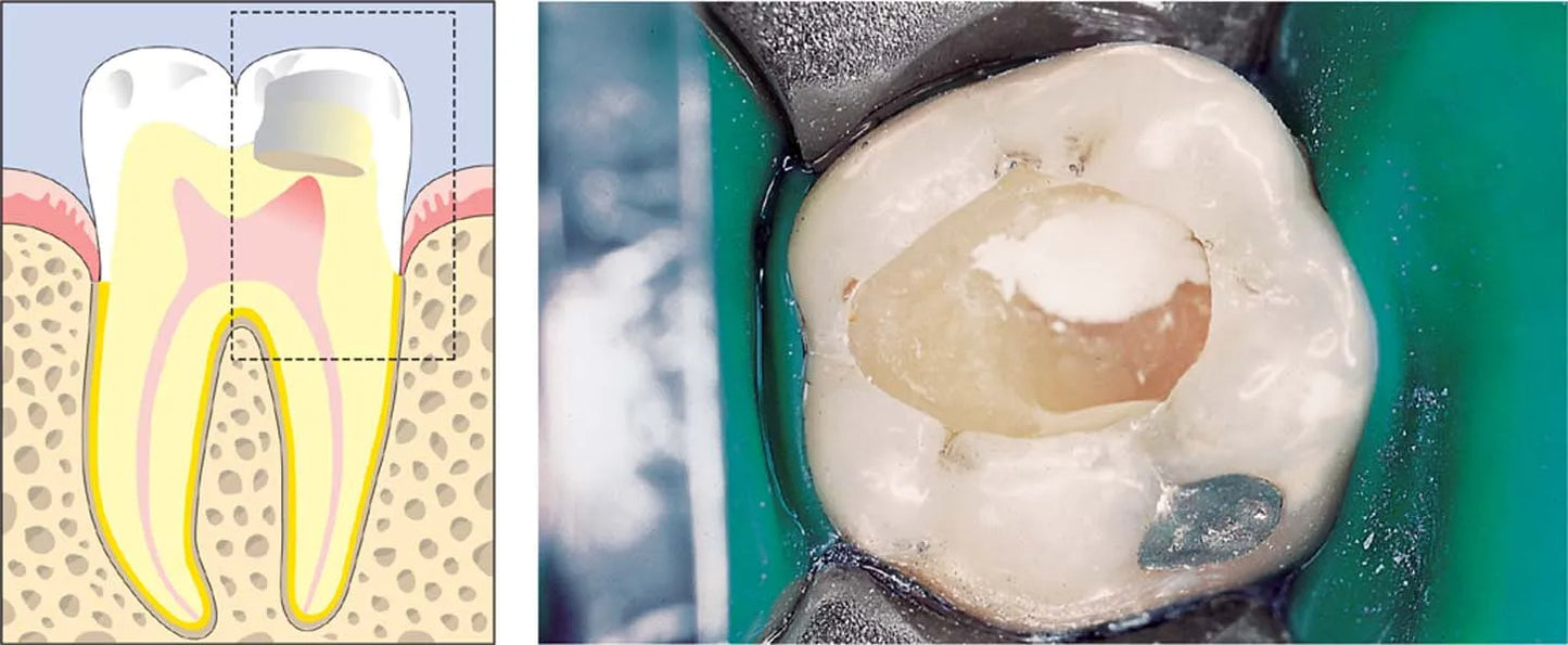 SafeEndo ReGlass Light Cure Gic