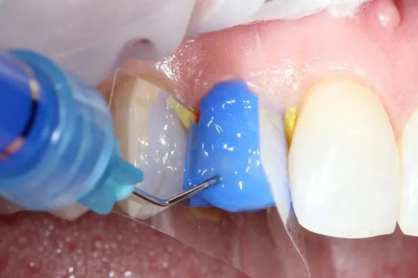 Safe Endo Smart Etch - Etching Gel 25ML