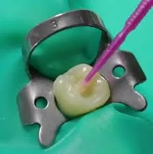 Anabond Stedbond - S Single Solution Bonding Agent