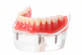 4 Implant Model 