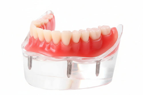 4 Implant Model 