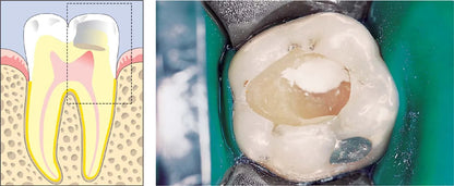 SafeEndo ReGlass Light Cure Gic