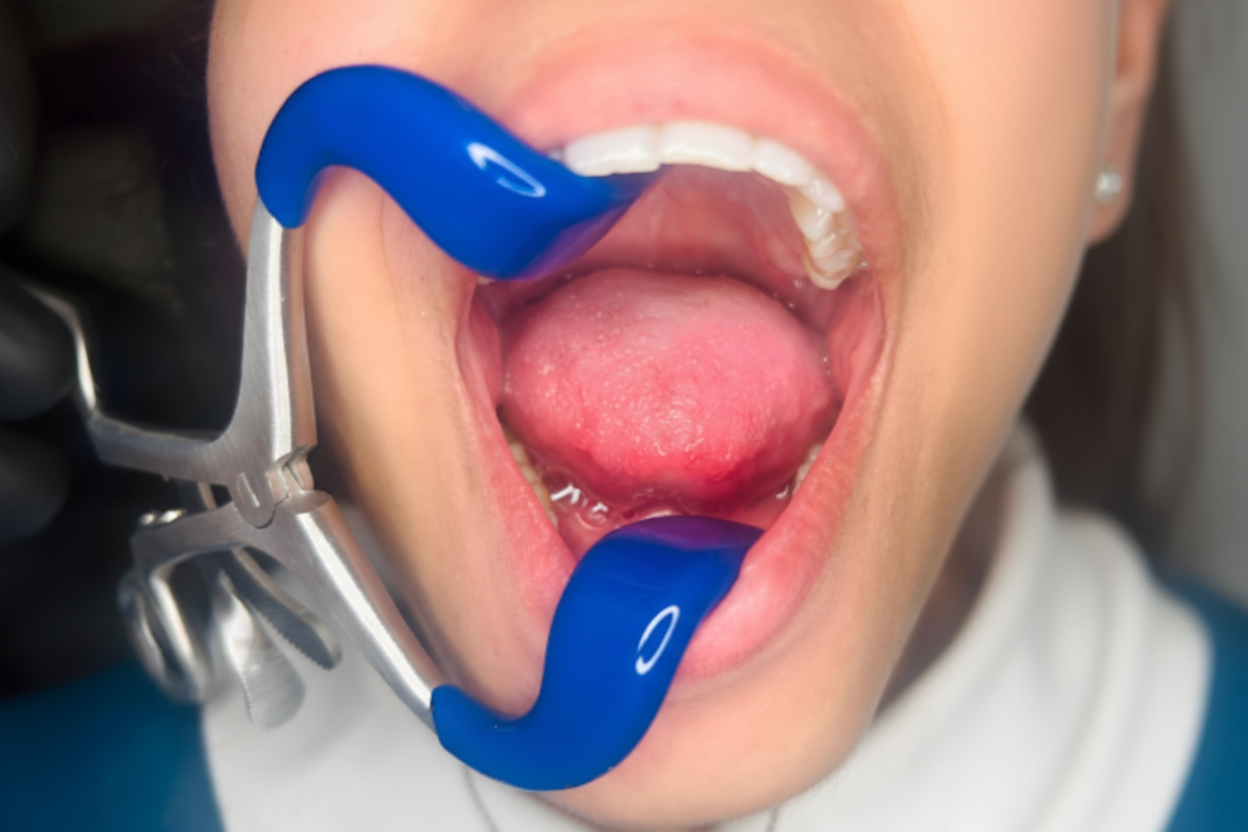 Mouth Gag Retractor