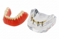 Implant Model With Bar  Full-Jaw