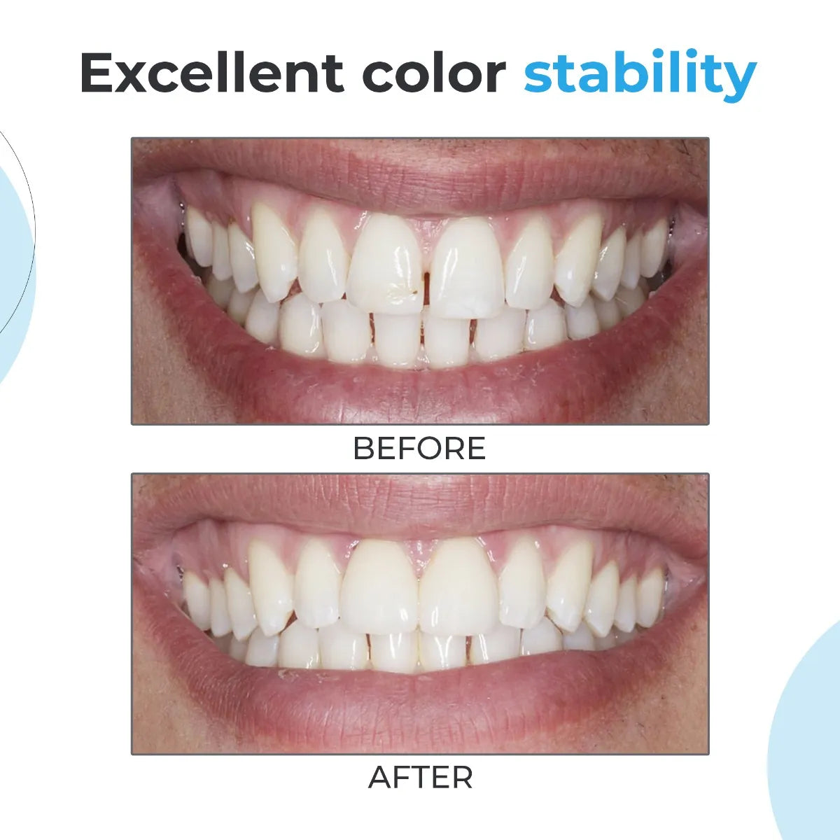 Waldent NanoFill Zirconium Composite Kit