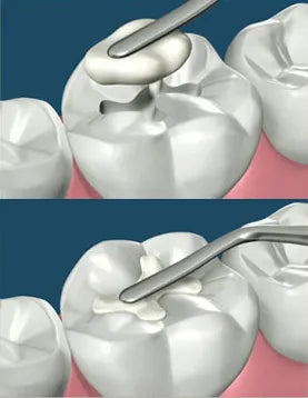 Tokuyama Palfique LX5 Syringe Refill