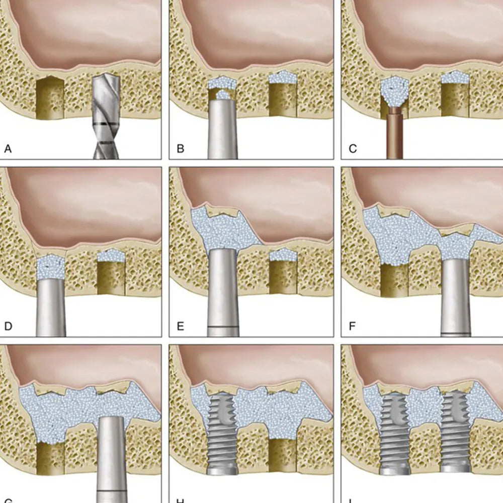 Osteotome Convex 