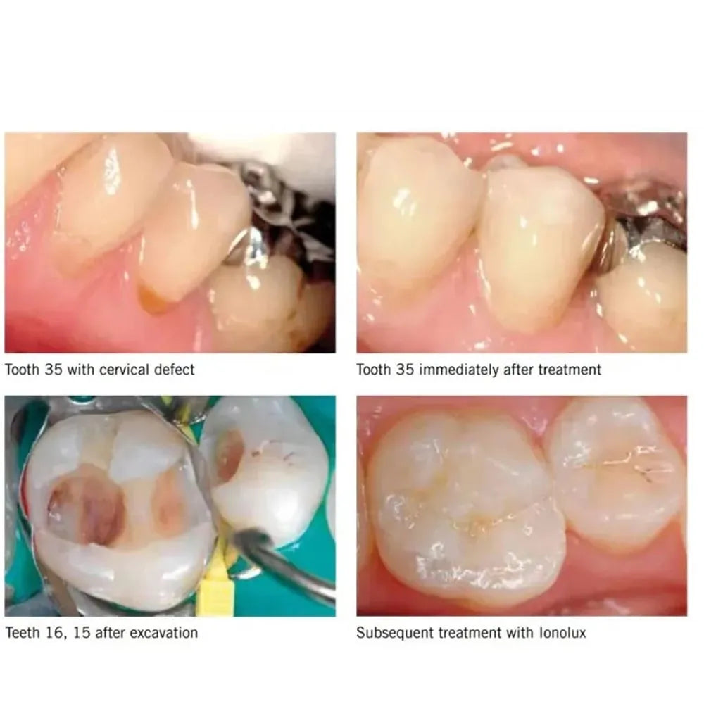 SafeEndo Glassy Restore Type-2 & Type-9 Glass Ionomer Cement