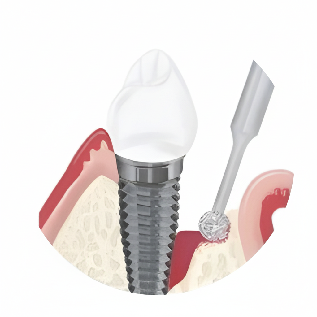 Granulation Tissue Removal Bur 